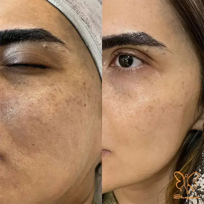  تزریق پی آرپی صورت در مشهد