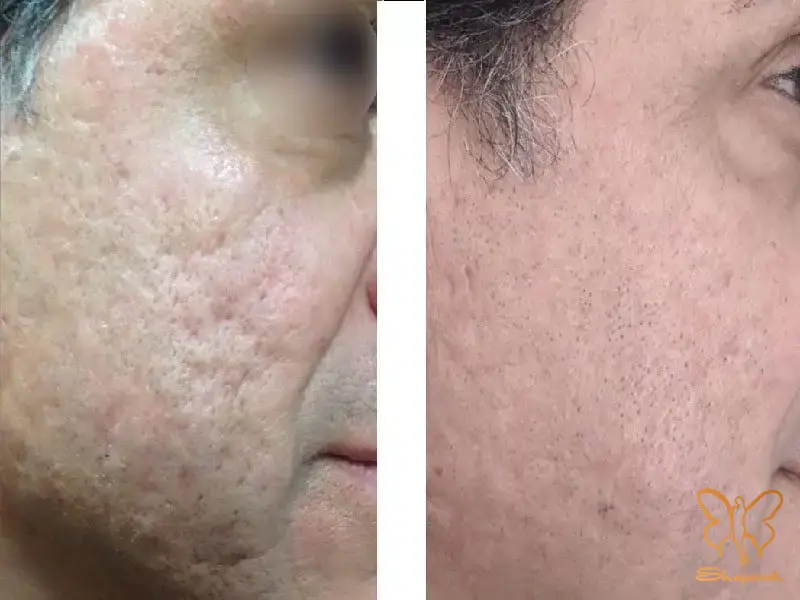 تولید کلاژن و الاستین سازی تولید کلاژن و الاستین سازی