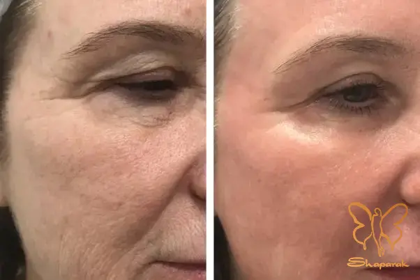 کلینیک تخصصی لیزر موهای زائد شاپرک طلایی مشهد