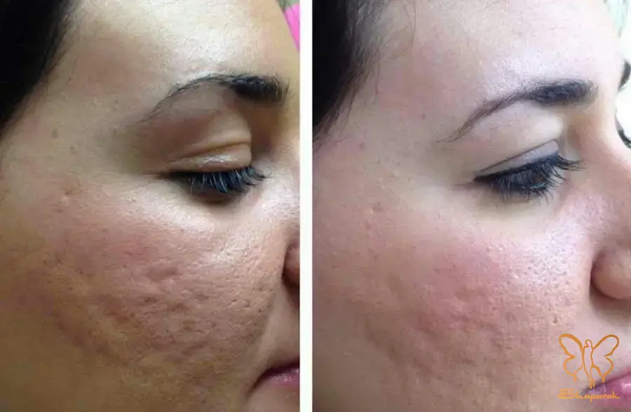 میکرونیدلینگ برای جوانسازی پوست مشهد