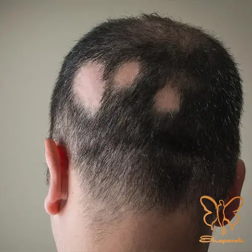 ۳ کاهش التهاب فولیکولی ۳ کاهش التهاب فولیکولی