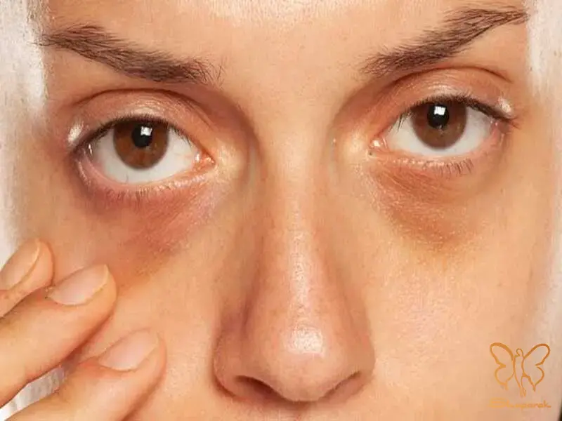 حلقه های تیره در زیر چشم