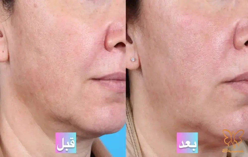 جوانسازی پوست مشهد تزریق پی آر پی PRP صورت و زیر چشم