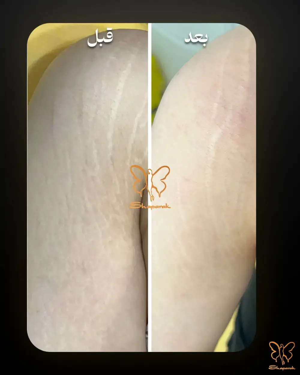 درمان ترک پوستی با مزو PDRN