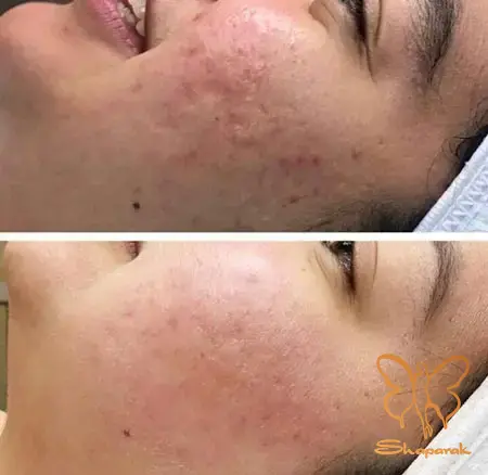  سلول های فیبروبلاست