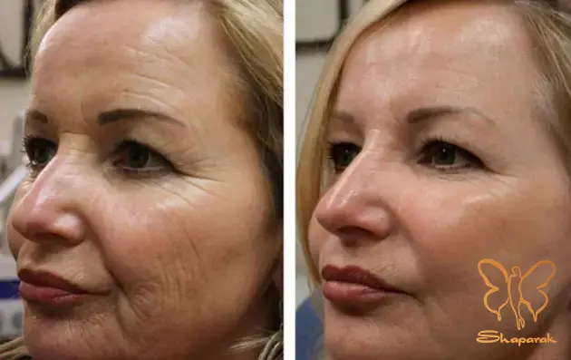 تزریقات جوانسازی انتخاب هوشمندانه در کلینیک شاپرک مشهد تزریقات جوانسازی انتخاب هوشمندانه در کلینیک شاپرک مشهد