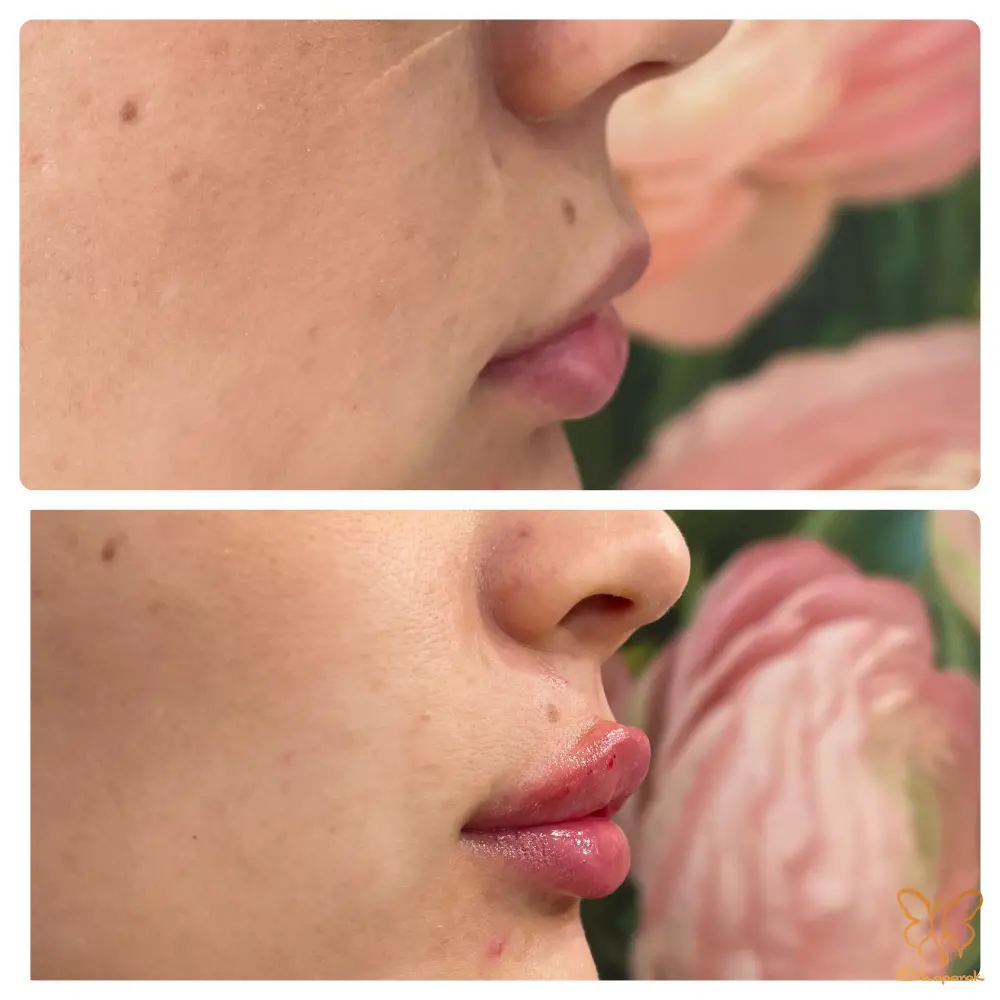 مراحل تخلیه ژل و تزریق مجدد در کلینیک شاپرک مشهد مراحل تخلیه ژل و تزریق مجدد در کلینیک شاپرک مشهد