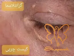 علت به وجود آمدن گزانتلاسما علت به وجود آمدن گزانتلاسما