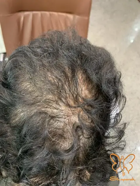 کلینیک شاپرک مشهد بررسی ارتباط سن و جنسیت با ریزش موی تلوژن افلوویوم کلینیک شاپرک مشهد بررسی ارتباط سن و جنسیت با ریزش موی تلوژن افلوویوم