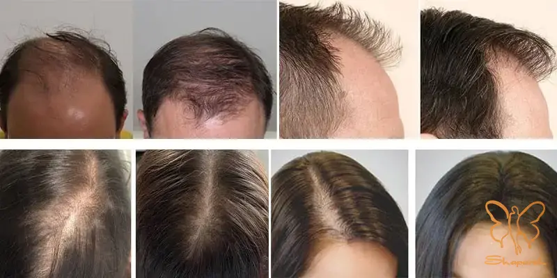 مزوتراپی مو مشهد مزوتراپی مو مشهد