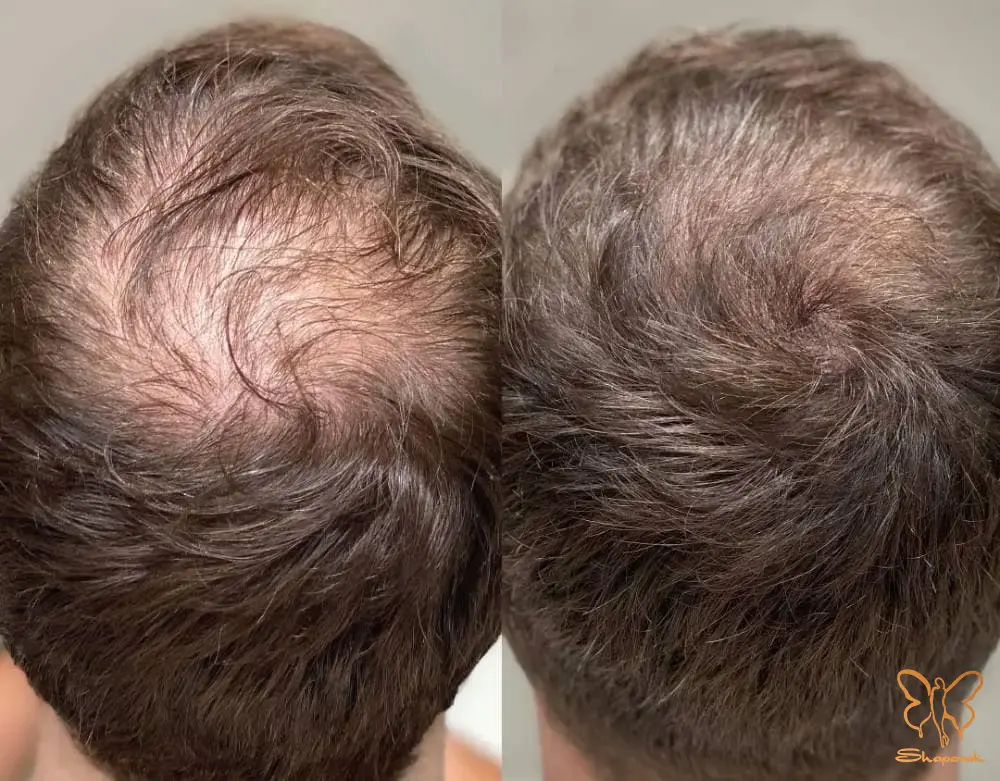 2 پی آر پی سر در مشهد 2 پی آر پی سر در مشهد