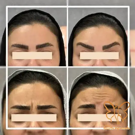 تزریق بوتاکس تزریق بوتاکس