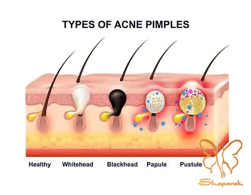 کیستها Cysts