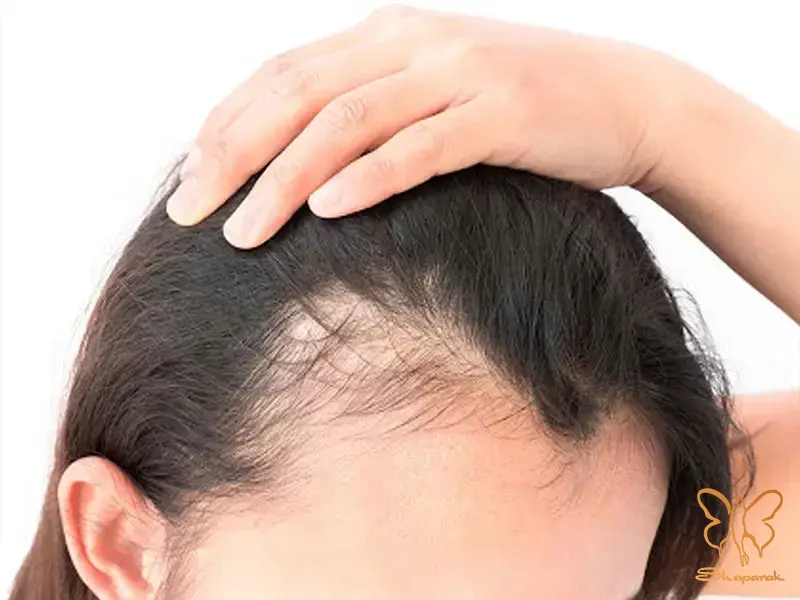 آلوپسی آره آتا آلوپسی آره آتا