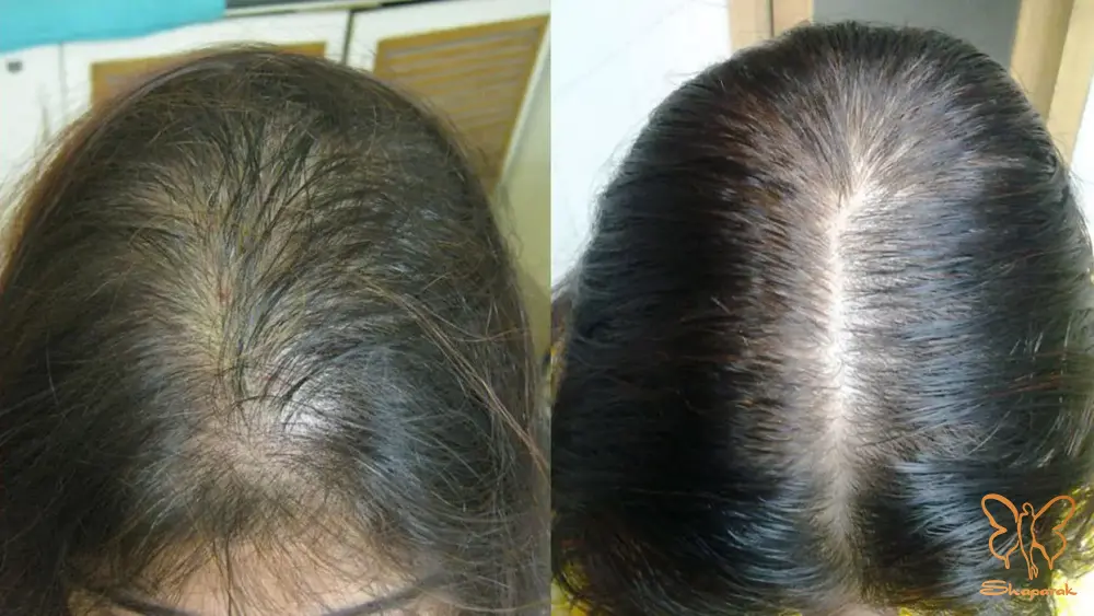 نقش داروها و تغییرات هورمونی در ریزش موی سر نقش داروها و تغییرات هورمونی در ریزش موی سر