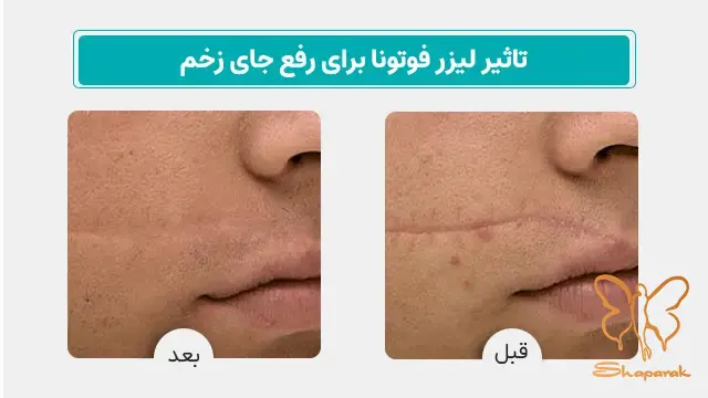 مزایای لیزر فوتونا فرکشنال در درمان جای اسکار