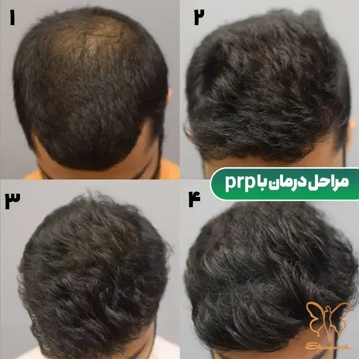 واکنش آلرژیک