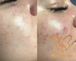 پاکسازی تخصصی پوست مشهد