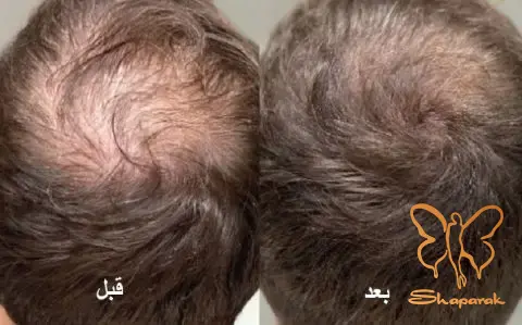 &nbsp;تزریق پی آرپی&nbsp;صورت در مشهد