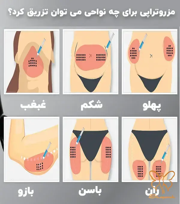 مزو بایواستتیکس چربی سوز در مشهد Meso Bioestetic Lipolytic