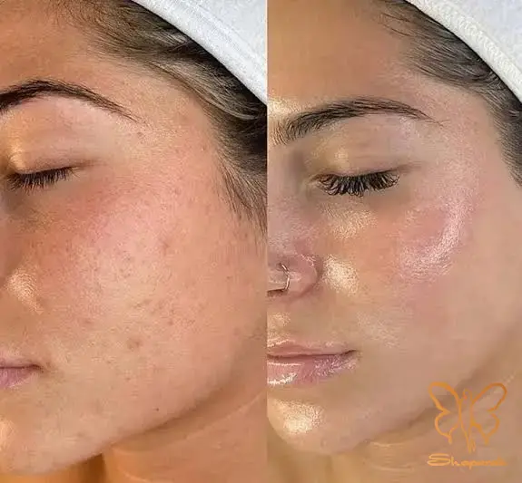 مزوژل های جوانساز پوست مشهد