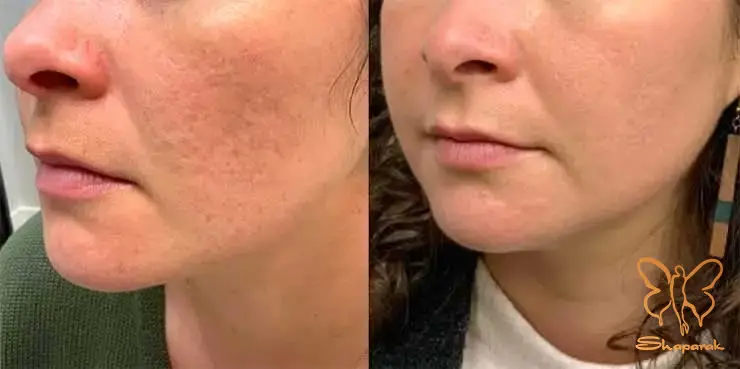 &nbsp;تزریق پی آرپی&nbsp;صورت در مشهد