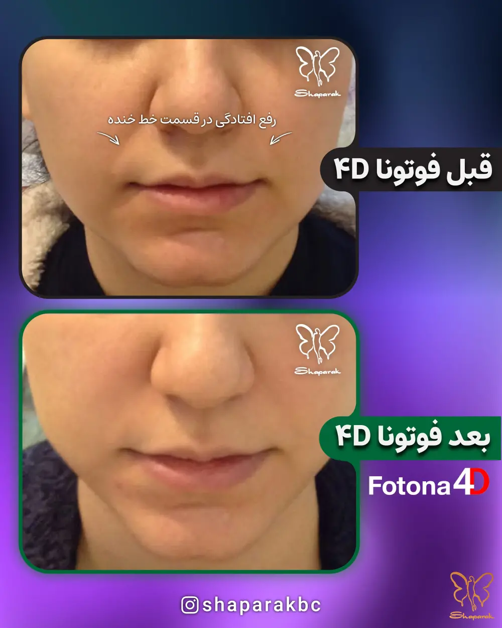 تزریق اسکالپچرا برای رفع افتادگی پوست صورت