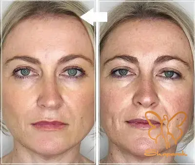 مزو بایواستتیکس آبرسان در مشهد Meso Bioestetic Hydration