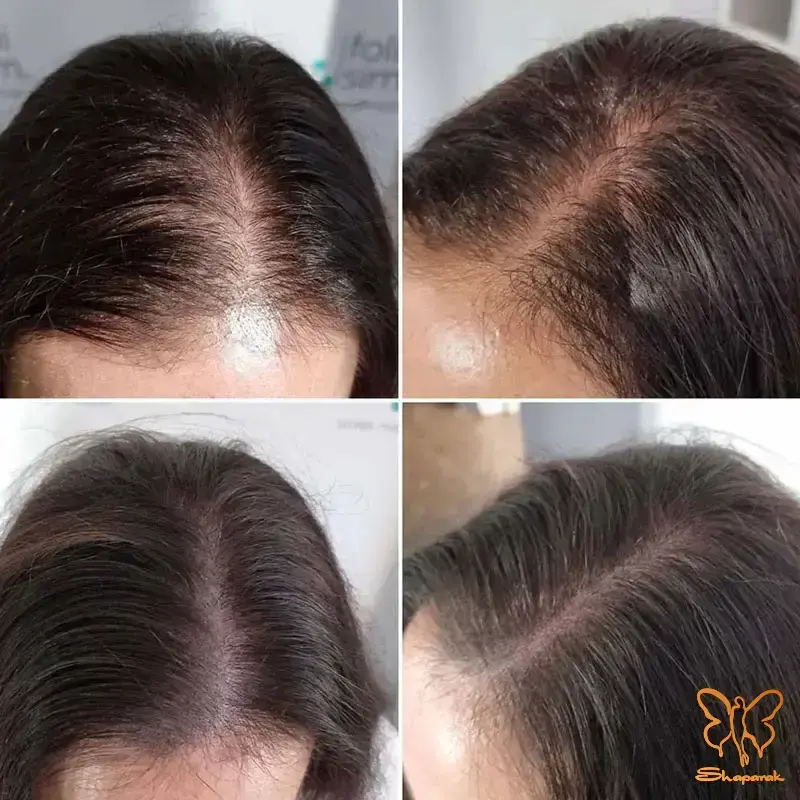 مزوتراپی درمانی معجزه آسا از ریزش مو تا جوانسازی پوست در مشهد