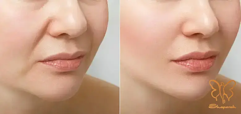 2 تحریک تولید کلاژن