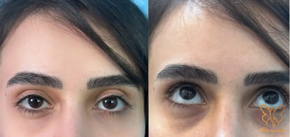 تزریق فیلر در مشهد
