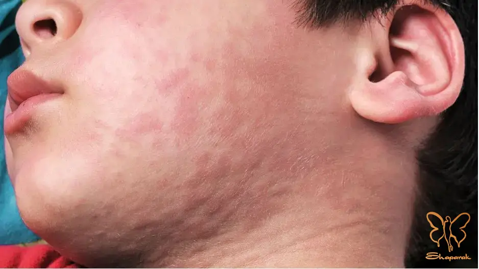 کهیر Urticaria در پوست دقیقا چه اتفاقی می افتد کهیر Urticaria در پوست دقیقا چه اتفاقی می افتد