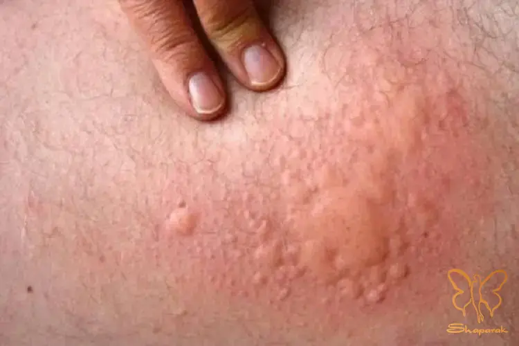 علائم اصلی کهیر Urticaria چگونه آن را تشخیص دهیم علائم اصلی کهیر Urticaria چگونه آن را تشخیص دهیم