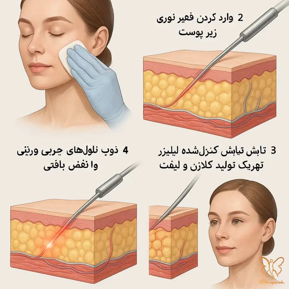 اندولیفت