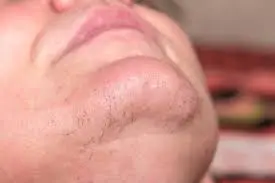 چرا نباید موهای سفید را لیزر کرد