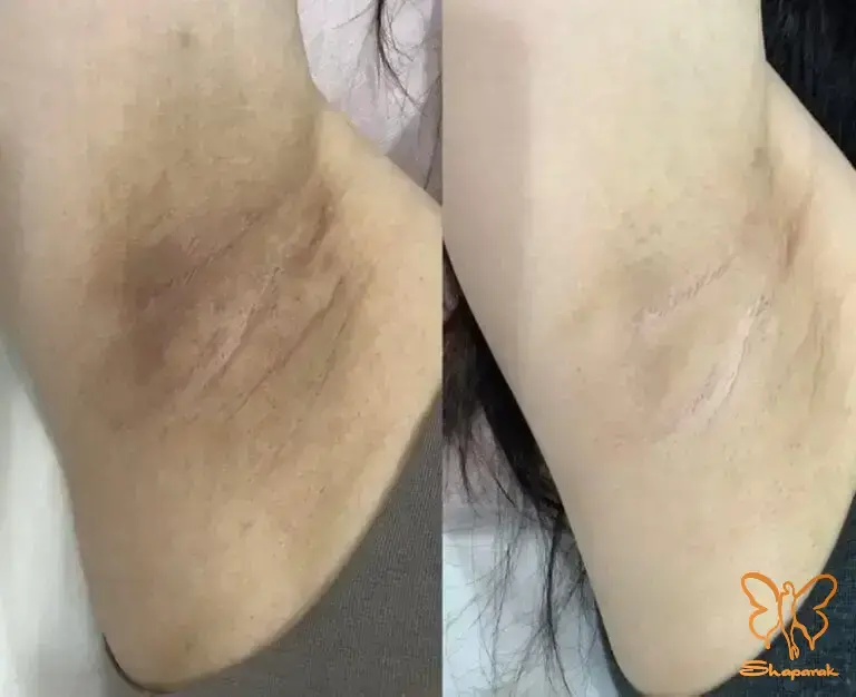 رفع تیرگی صورت و زیر بغل با کربوکسی تراپی در مشهد