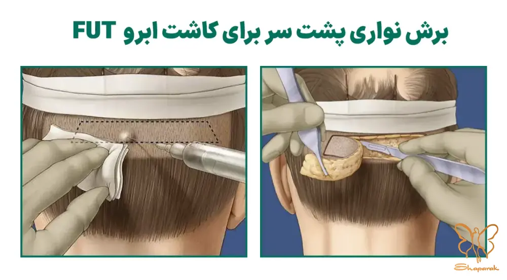 کاشت ابرو در مشهد به روش FUT کاشت ابرو در مشهد به روش FUT