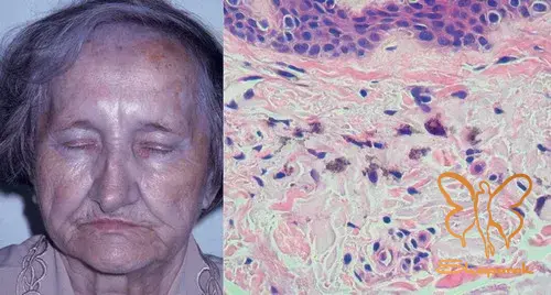 آیا بیماری آرگیریا ژنتیکی خودایمنی یا مسری است آیا بیماری آرگیریا ژنتیکی خودایمنی یا مسری است