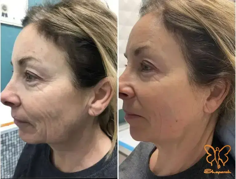 اندولیفت صورت در مشهد اندولیفت صورت در مشهد