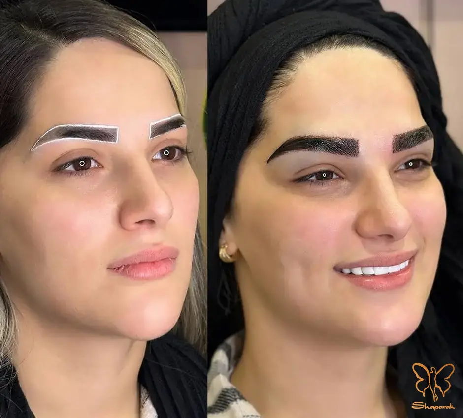 صفر تا صد مراحل کاشت ابرو در کلینیک شاپرک طلایی مشهد صفر تا صد مراحل کاشت ابرو در کلینیک شاپرک طلایی مشهد