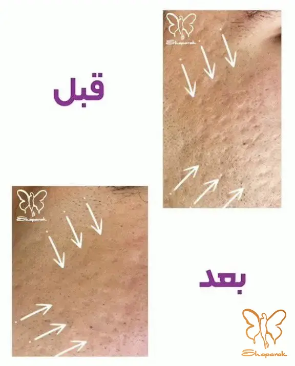 درمان جای جوش عمیق