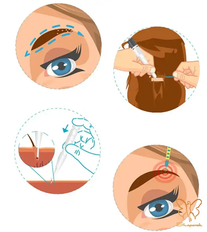 کاشت ابرو در مشهد به روشFIT Follicular Isolation Technique کاشت ابرو در مشهد به روشFIT Follicular Isolation Technique