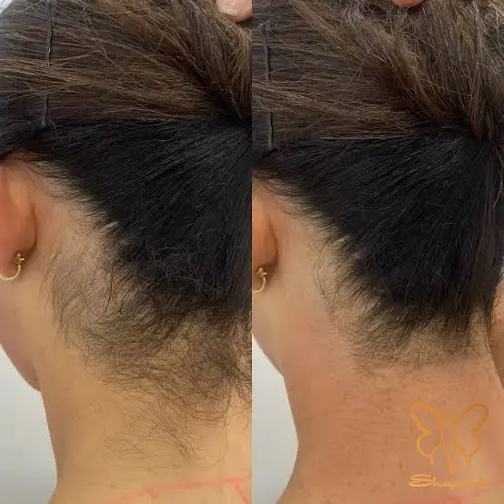 کلینیک تخصصی پوست و مو شاپرک طلایی مشهد کلینیک تخصصی پوست و مو شاپرک طلایی مشهد