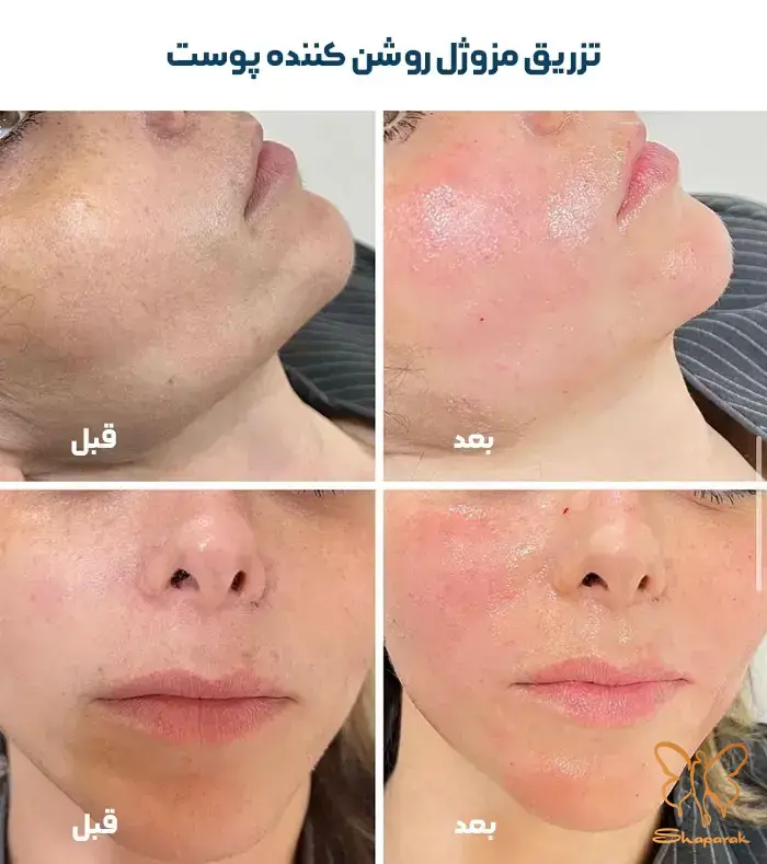 مزوژل های جوانساز پوست مشهد