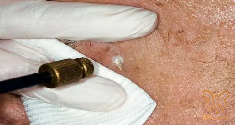 لیزر CO2 در مشهد لیزر CO2 در مشهد