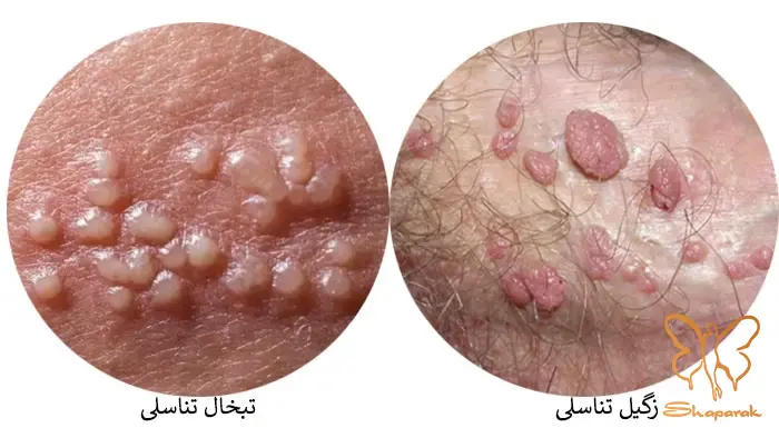 تبخال تناسلی Genital Herpes چیست ویروسی پایدار تبخال تناسلی Genital Herpes چیست ویروسی پایدار
