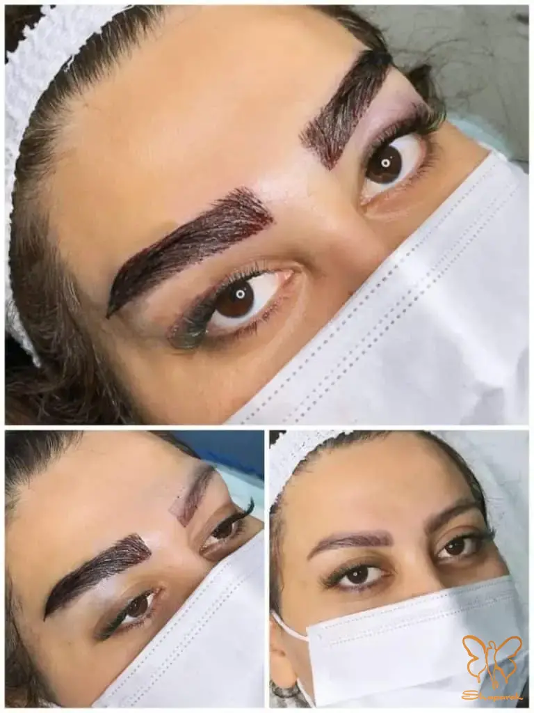 استفاده از پماد های موضعی استفاده از پماد های موضعی