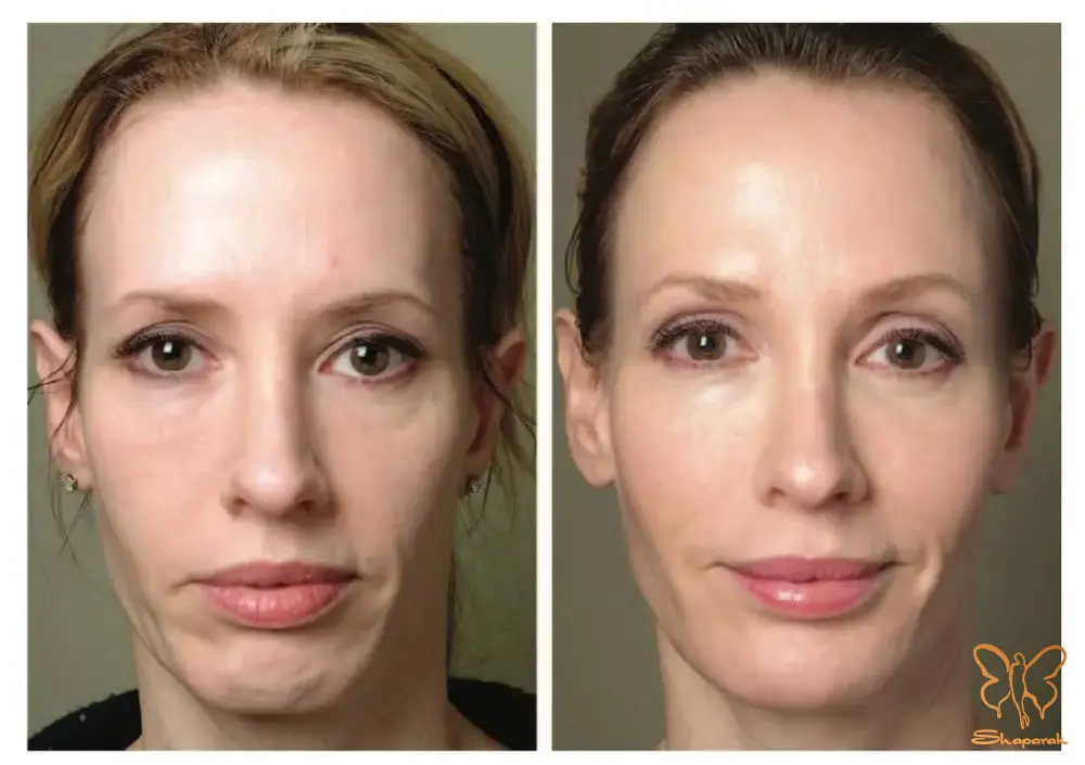 کلینیک تخصصی لیزر موهای زائد شاپرک طلایی در مشهد کلینیک تخصصی لیزر موهای زائد شاپرک طلایی در مشهد