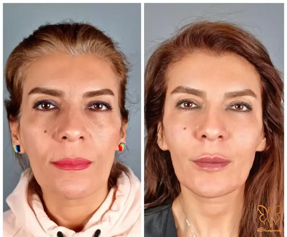 کلاژن و الاستین سازی پوست کلاژن و الاستین سازی پوست