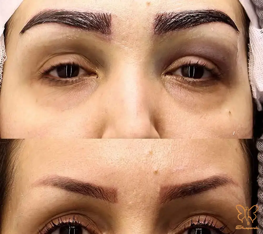 کاندید های ایده آل برای کاشت ابرو آیا شما فرد مناسبی هستید کاندید های ایده آل برای کاشت ابرو آیا شما فرد مناسبی هستید